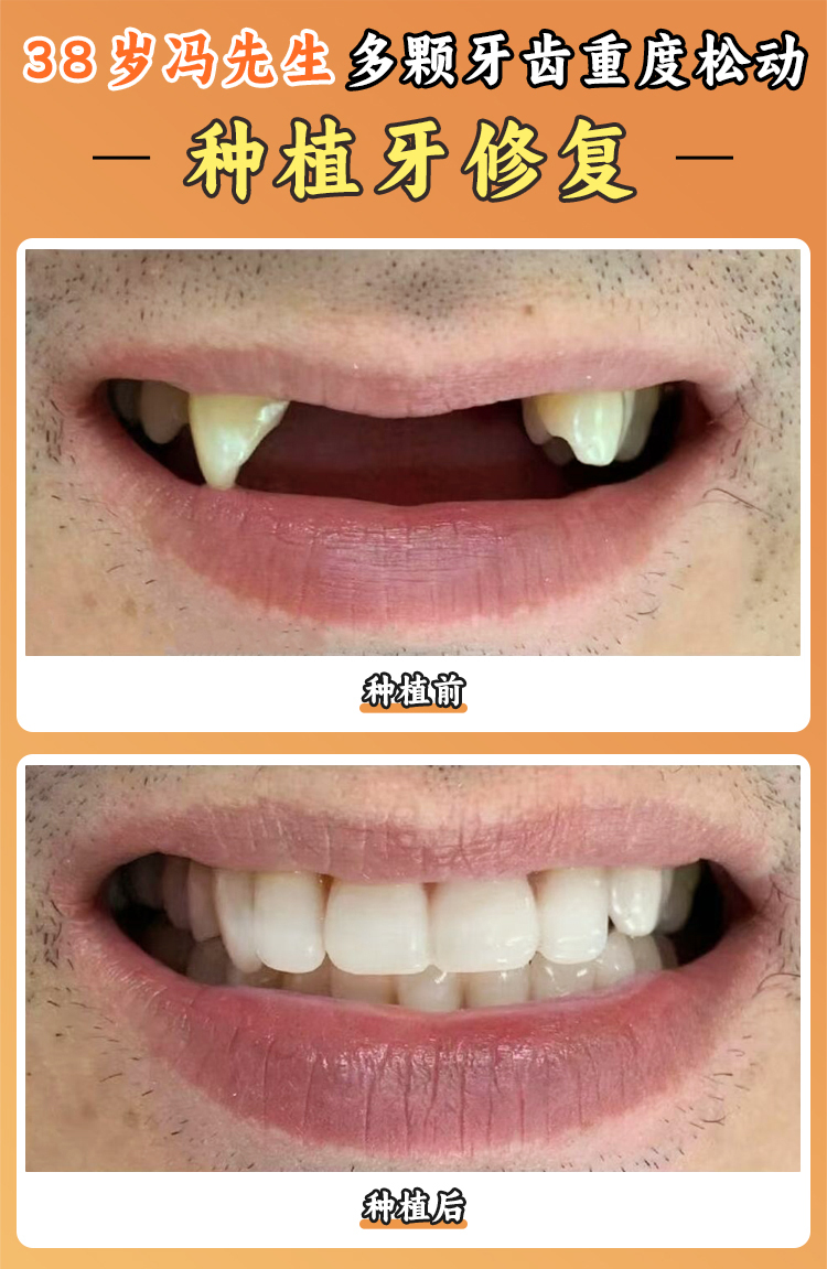 種植牙項(xiàng)目?jī)r(jià)格：多種品牌，適應(yīng)不同預(yù)算