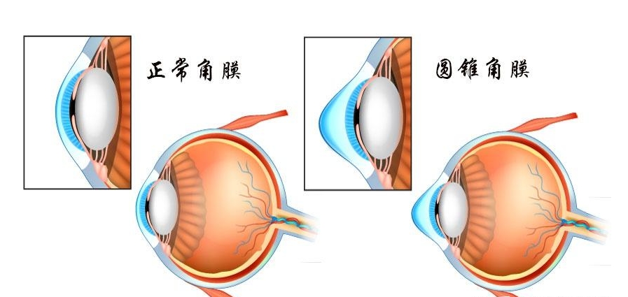 東莞光明眼科的近視手術(shù)項(xiàng)目怎么樣？