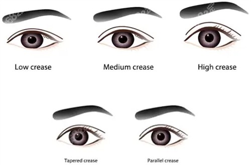 不同類型的雙眼皮 不同類型的雙眼皮