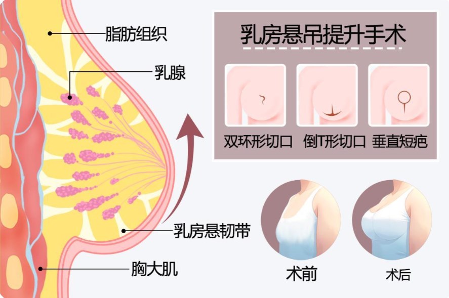 北京劉春軍醫(yī)生隆胸的費(fèi)用