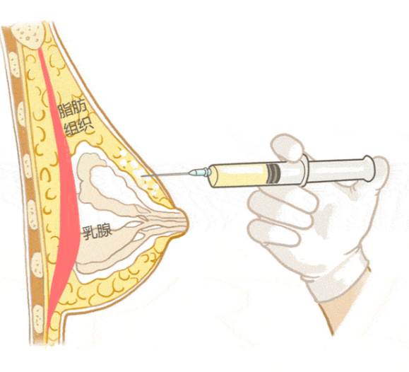 董巖巖隆胸可靠性與療效常見(jiàn)疑問(wèn)解答