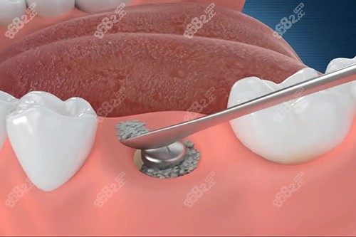 微創(chuàng)種植牙基臺安裝示意圖