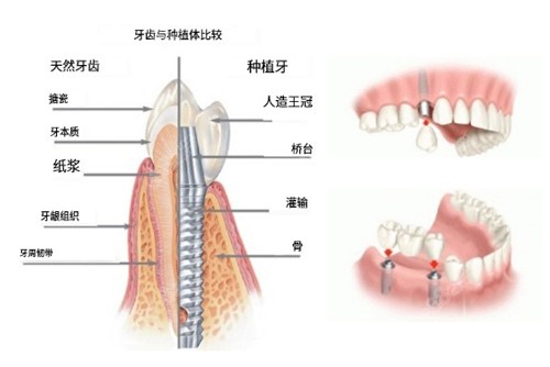 種植牙構(gòu)造圖