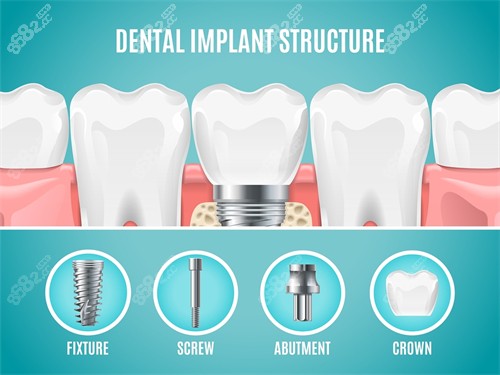 種植牙植體組成部分展示