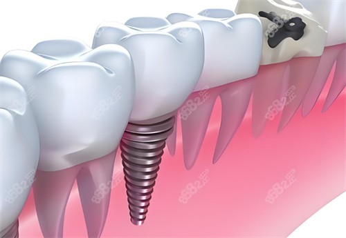 種植牙卡通展示
