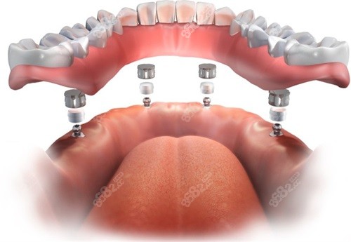 半口種植牙牙冠安裝示意圖