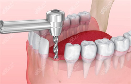 種植牙過程動畫展示