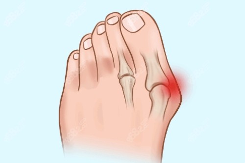 大腳骨疼痛卡通圖