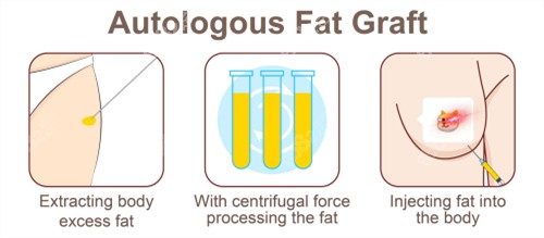 自體脂肪隆胸