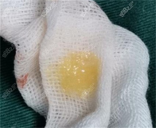 生長因子剛剛注射后取出的樣子