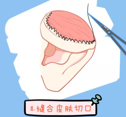 關(guān)于 河南張正文和王江允誰(shuí)耳再造做的更自然不假？，用戶較常問(wèn)的幾個(gè)問(wèn)題（FAQ）