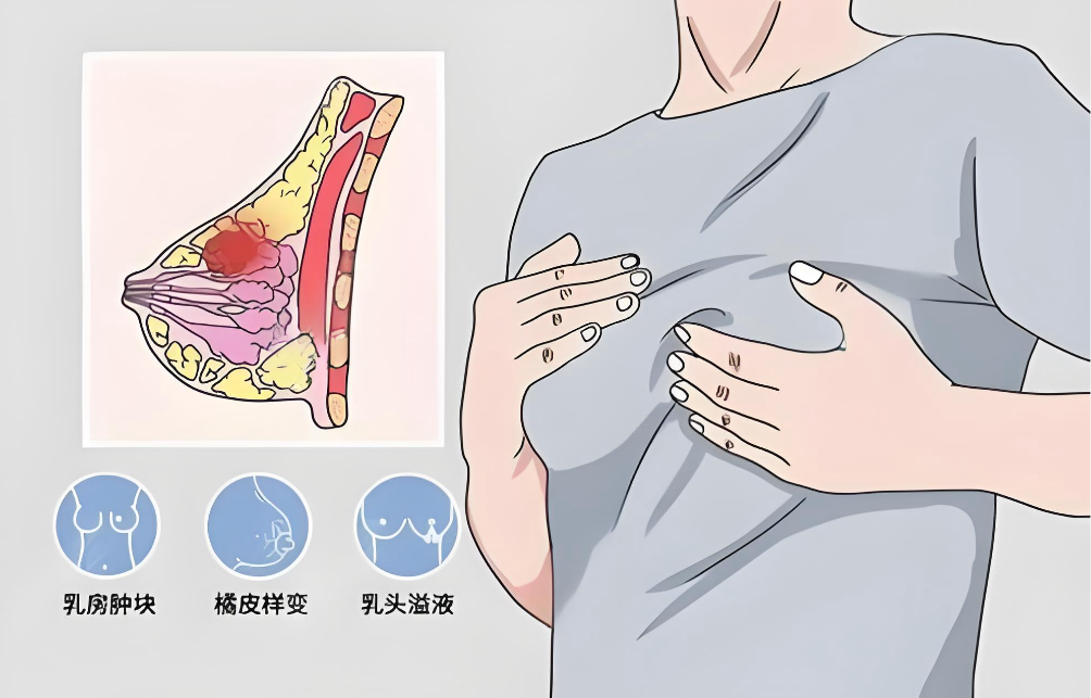 楊慶華胸部奧美定取出