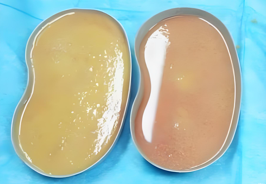 楊慶華奧美定取出核心技術(shù)