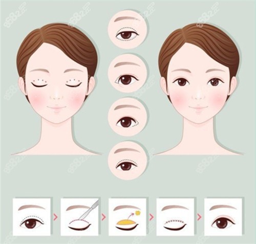 切開雙眼皮手術(shù)前后對比和過程