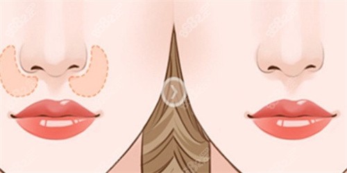 鼻基底填充對比