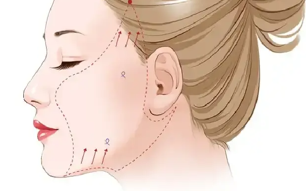 王春虎和楊曉寧做面部筋膜提升哪個好？王春虎技術精細，楊曉寧方案個性化