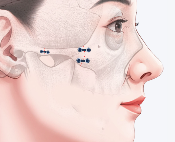 上海劉雙立磨骨改變大不大？真實體驗分享手術細節(jié)含術后護理事項