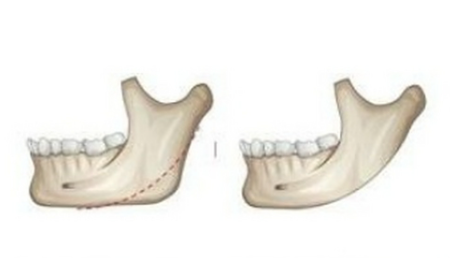 上海劉雙立磨骨的成功實(shí)例展示