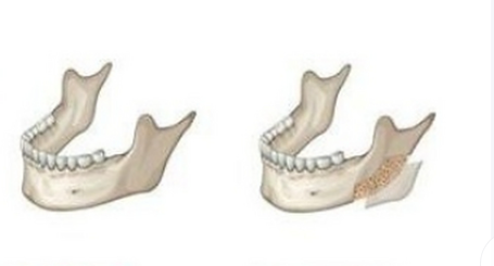 上海劉雙立磨骨的特色技術(shù)