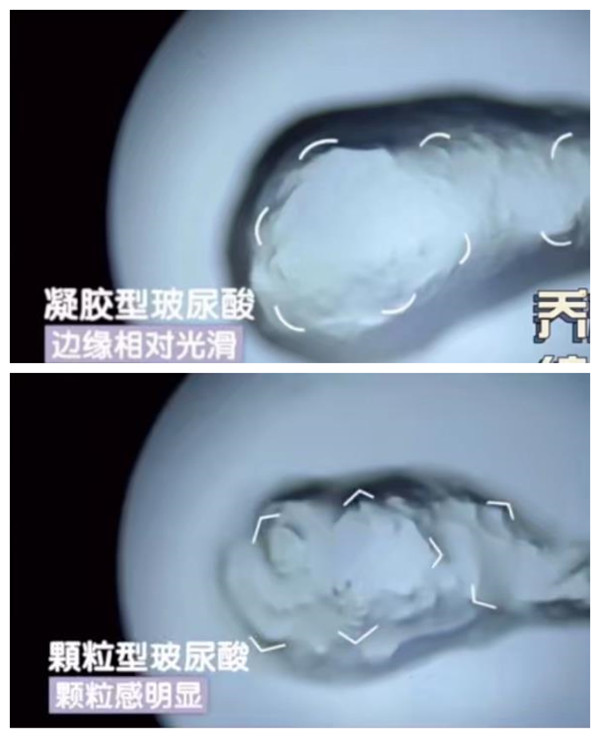 五、泊沃林跟乔雅登玻尿酸常见问题解答