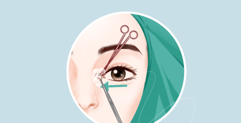 二、手術(shù)復(fù)雜程度如何影響北京美萊葉宇修復(fù)內(nèi)眼角什么價(jià)位的價(jià)格