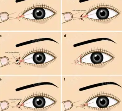 四、北京美萊葉宇修復(fù)內(nèi)眼角什么價(jià)位的核心價(jià)格區(qū)間參考