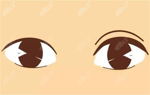 雙眼皮手術(shù)的前后對比
