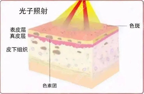 光子嫩膚原理卡通示意圖