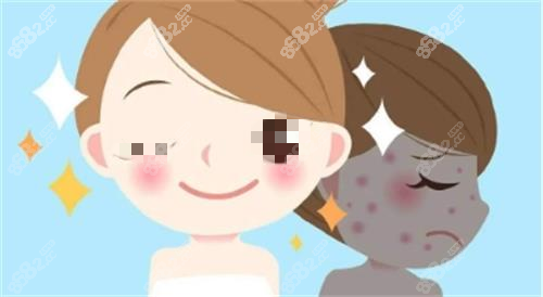 光子嫩膚成效圖