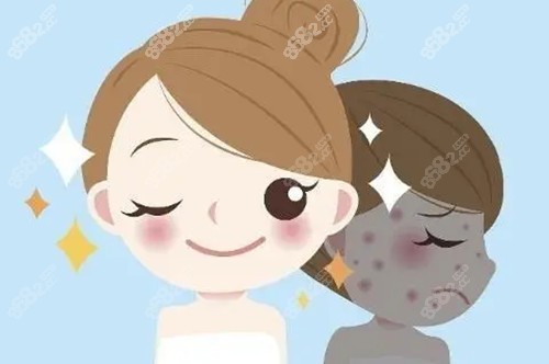 光子嫩膚前后對(duì)比卡通示意圖