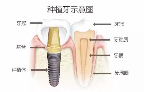 唐山種植牙多少錢一顆？26年收費(fèi)價(jià)目表揭曉，單顆價(jià)格從1980元到20000元