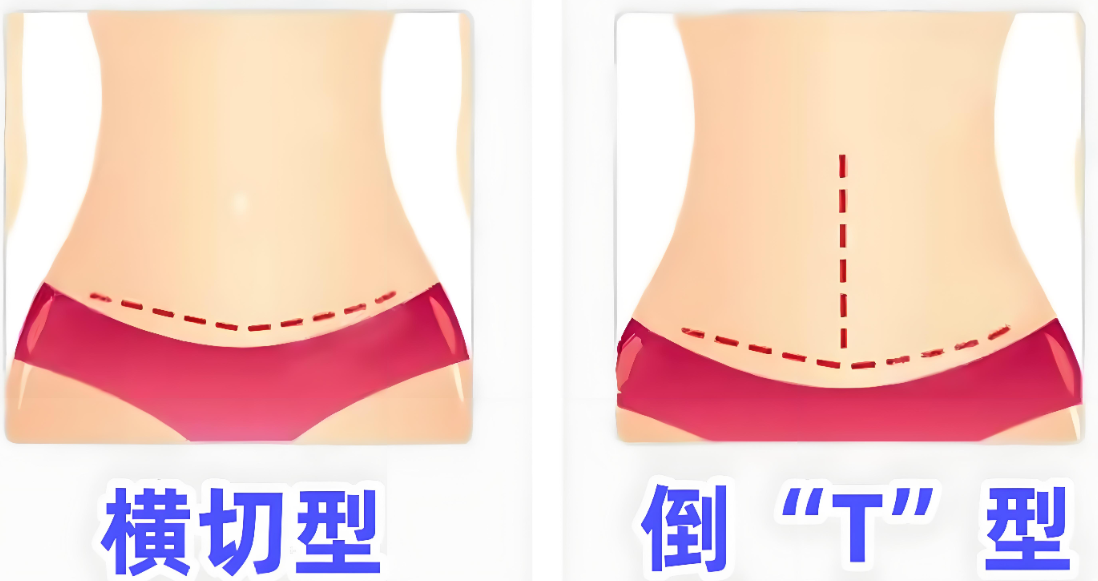 夏學(xué)穎醫(yī)生腹壁成形用戶口碑與注意事項(xiàng)m.sorencai.cn