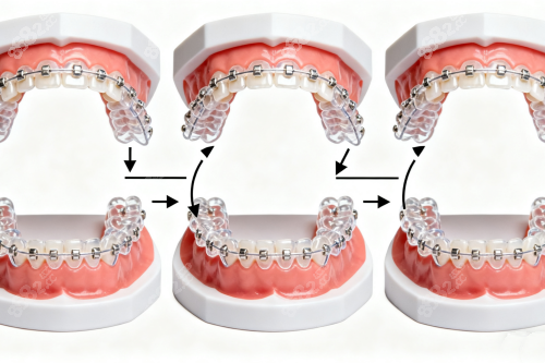 半隱形矯正卡通圖片