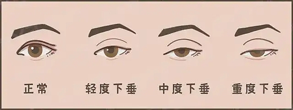 劉韶瑞眼修復技術(shù)靠譜嗎？靠譜！多次失敗也能救，肉條+寬深溝全改善，術(shù)后閉眼無痕自然媽生款