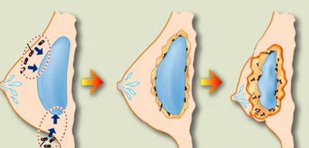 傅少梅醫(yī)生手術(shù)收費標(biāo)準(zhǔn)：胸部修復(fù)2萬起，面部填充3萬起，價格透明無隱形消費，真實價目表速領(lǐng)
