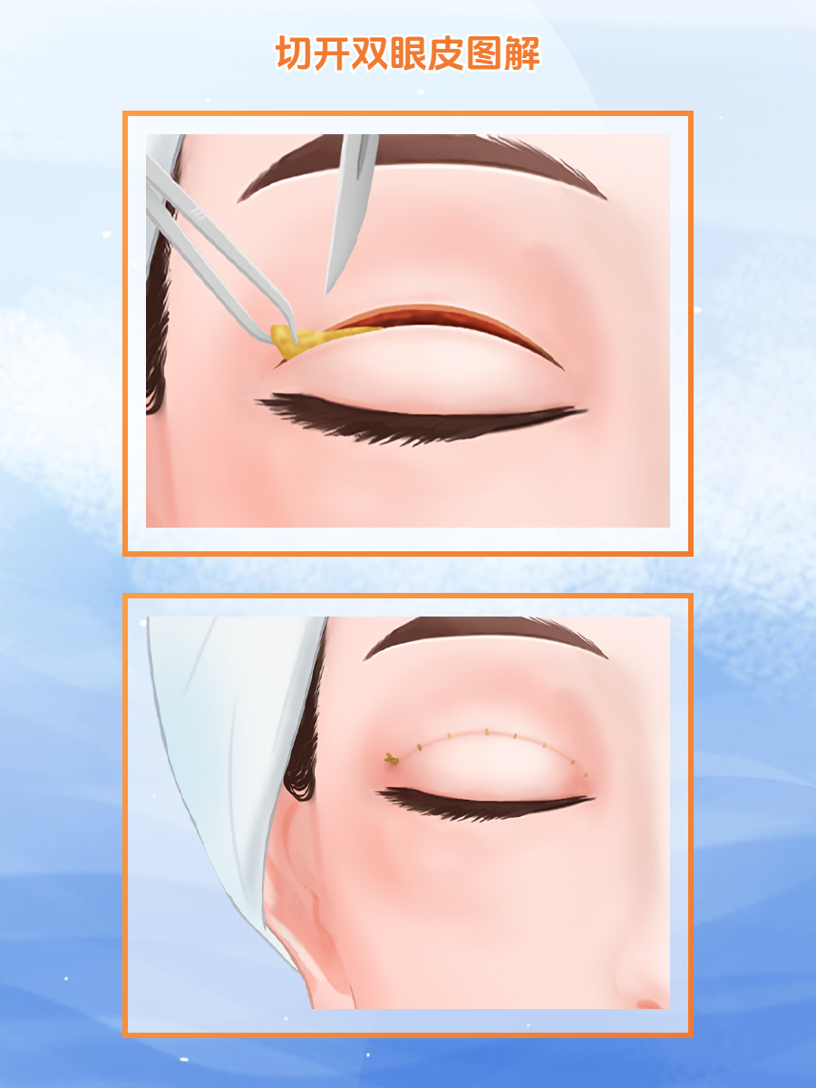 一、龍劍虹雙眼皮做得如何