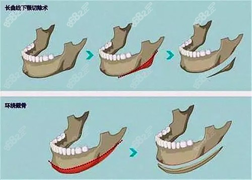 不同下頜骨結(jié)構(gòu)方式對(duì)比圖