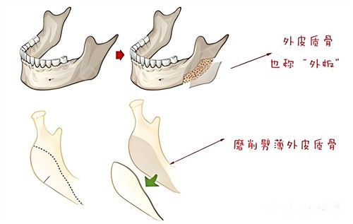 下頜骨切除術(shù)過(guò)程演示動(dòng)畫(huà)圖