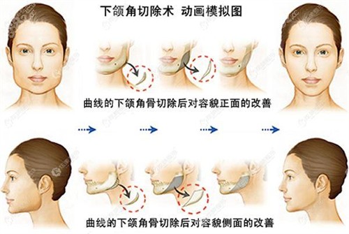 下頜角切除術(shù)動(dòng)畫模擬圖