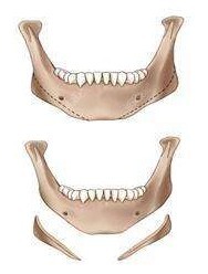 下頜角手術(shù)變化圖