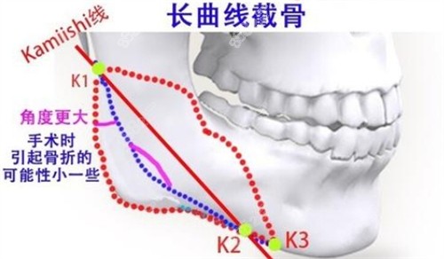 下頜角長(zhǎng)曲線截骨的截骨位置