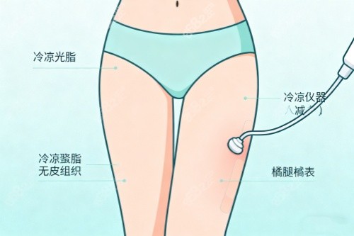 腿部做吸脂卡通圖一覽