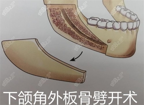 下頜角外板劈開(kāi)術(shù)