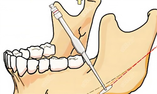 下頜角手術(shù)過(guò)程