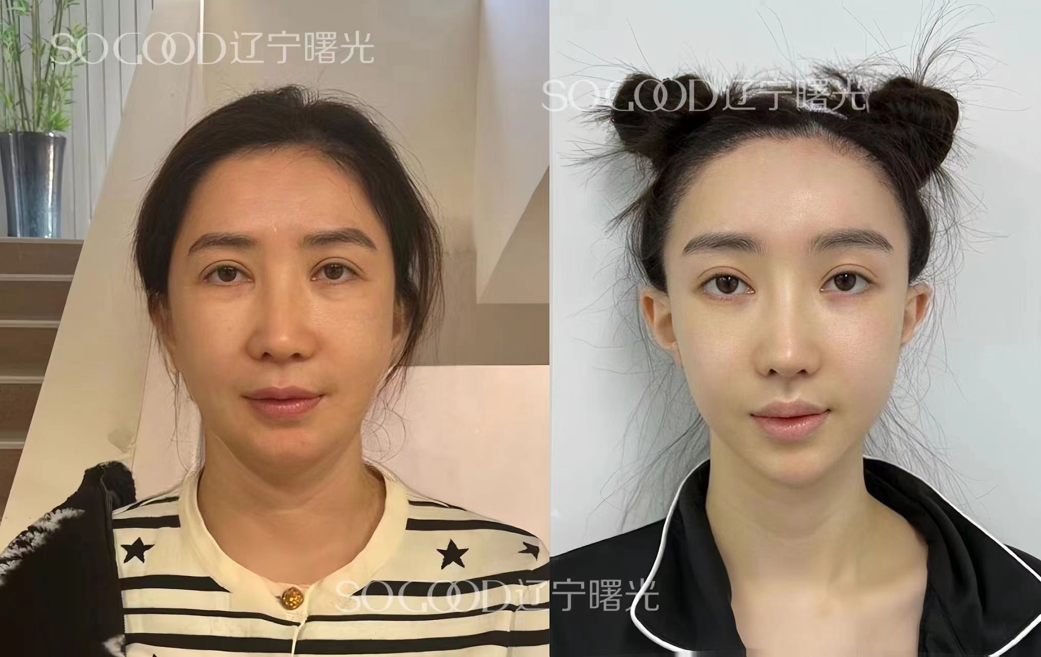 崔昌墉和于世川誰厲害？崔昌墉擅骨相重塑，于世川切口小恢復快各有千秋！ 