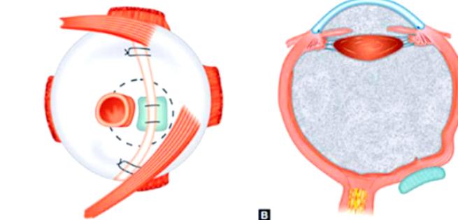 三、封康醫(yī)生做后鞏膜加固術(shù)多點(diǎn)執(zhí)業(yè)：資源下沉