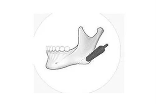 籍建華醫(yī)生磨骨做的好嗎？西安籍建華下頜角/顴骨內(nèi)推真實(shí)口碑與預(yù)約