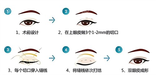 雙眼皮三點(diǎn)術(shù)過程原理