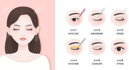 拉雙眼皮手術(shù)示意圖