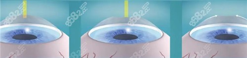 激光近視眼手術(shù)方式圖